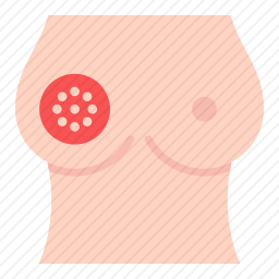 乳腺癌
