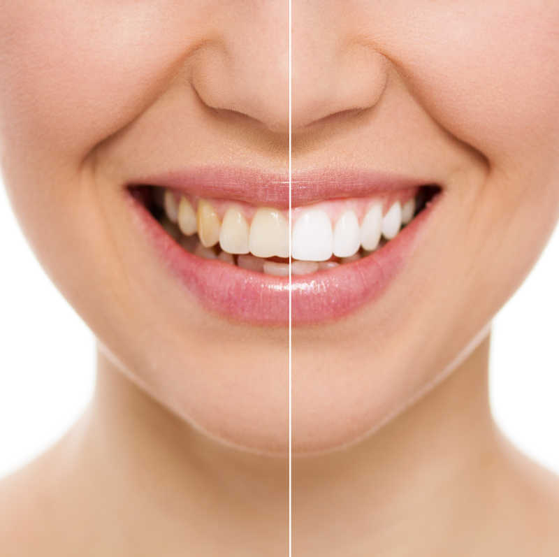 女人牙齿漂白前后对比