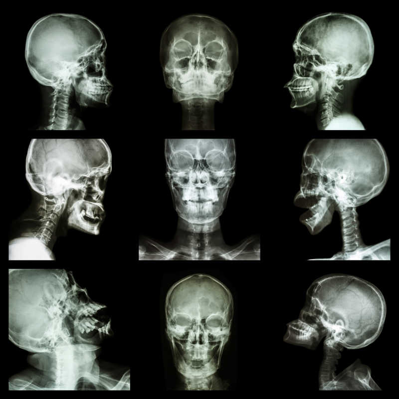 X射线下的头骨采集