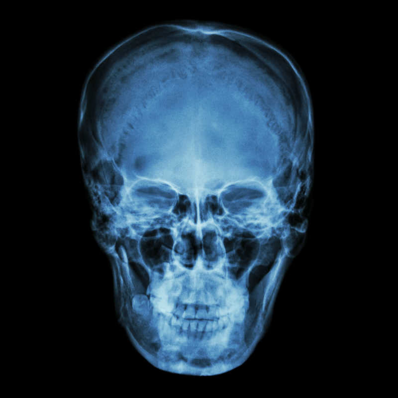 X射线下的头骨