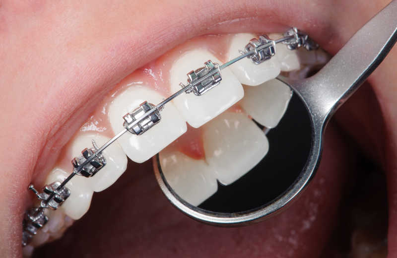 带着金属牙套的美女进行牙齿保健治疗