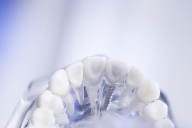 人体牙齿种植的模型展示