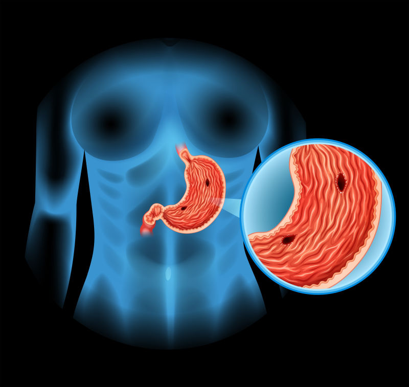 矢量人体中的胃溃疡插图