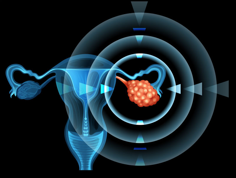 抽象矢量女性卵巢癌的图示插图