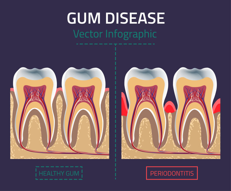 创意矢量牙龈疾病插图