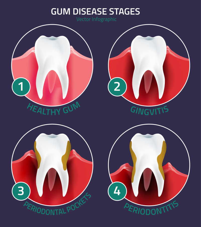 抽象矢量牙齿疾病的分期示意图