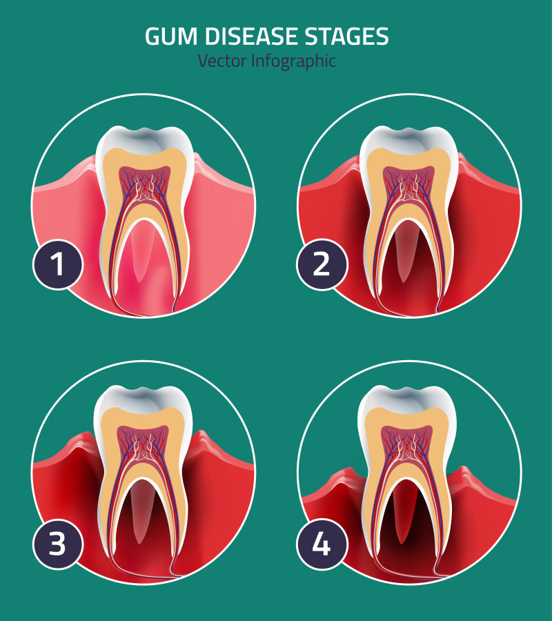 抽象矢量牙龈疾病的分解图解插图