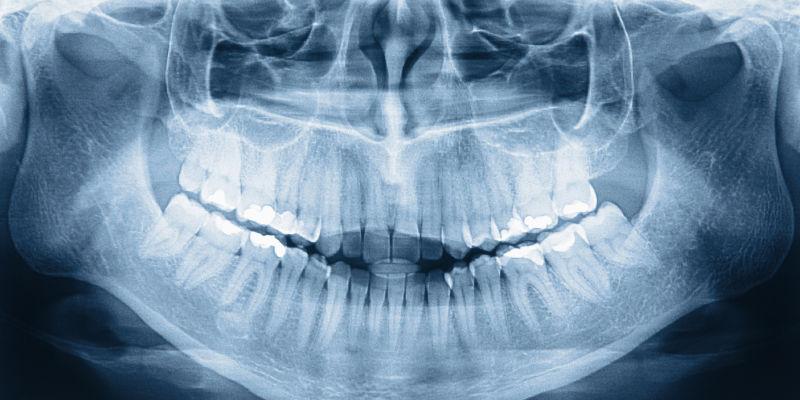 x射线下的牙齿骨骼图像
