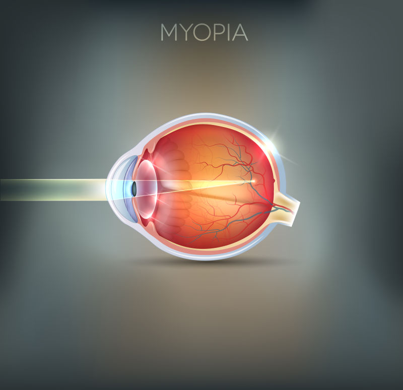 视力障碍的眼球矢量图