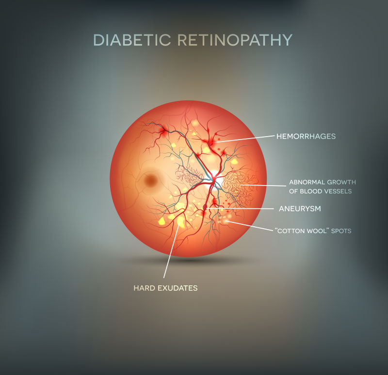 糖尿病视网膜病变的矢量图