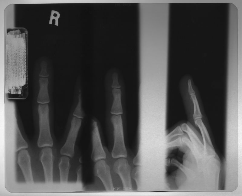 手指骨骼x射线片子