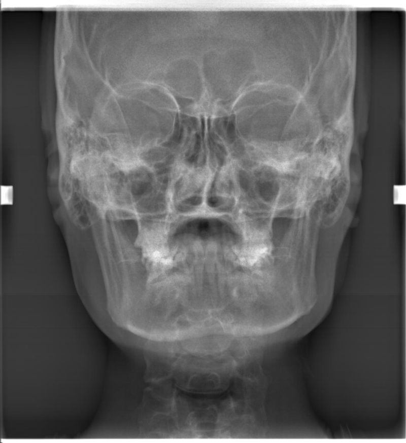 头部骨骼x射线片子