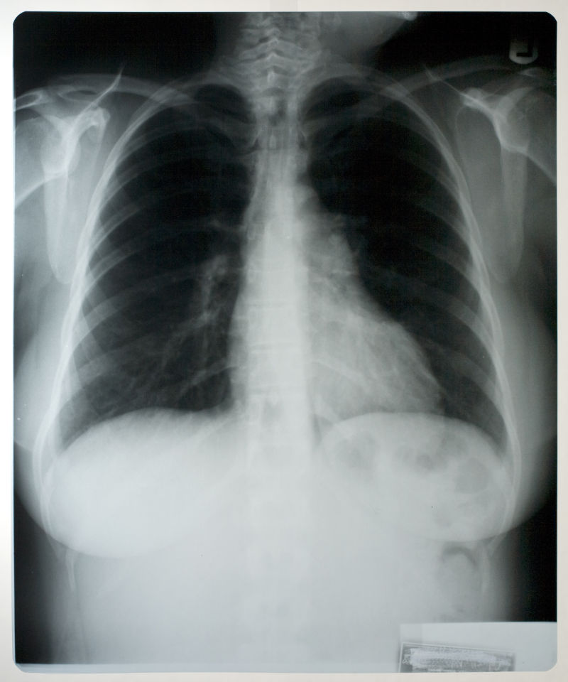 胸部透视x射线片子