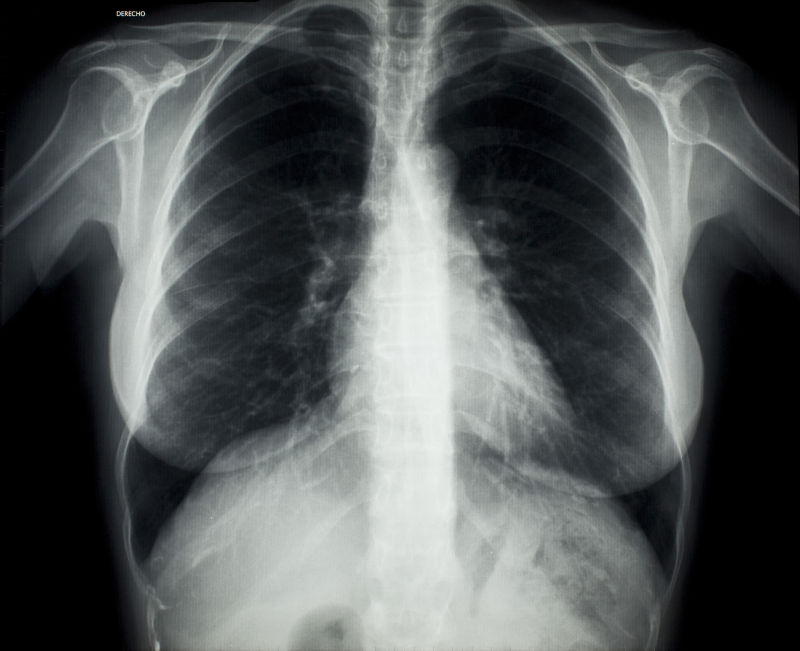 胸透肺部x射线片子