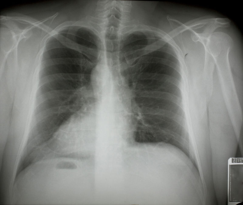 人体肺部骨骼x射线片子