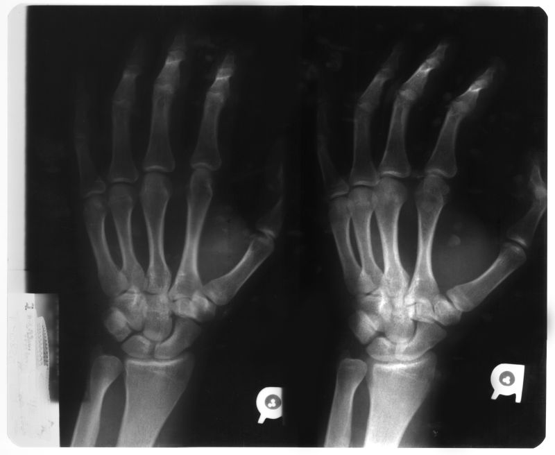 手掌骨骼x射线片子