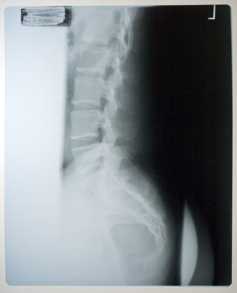 人体脊柱的x射线图