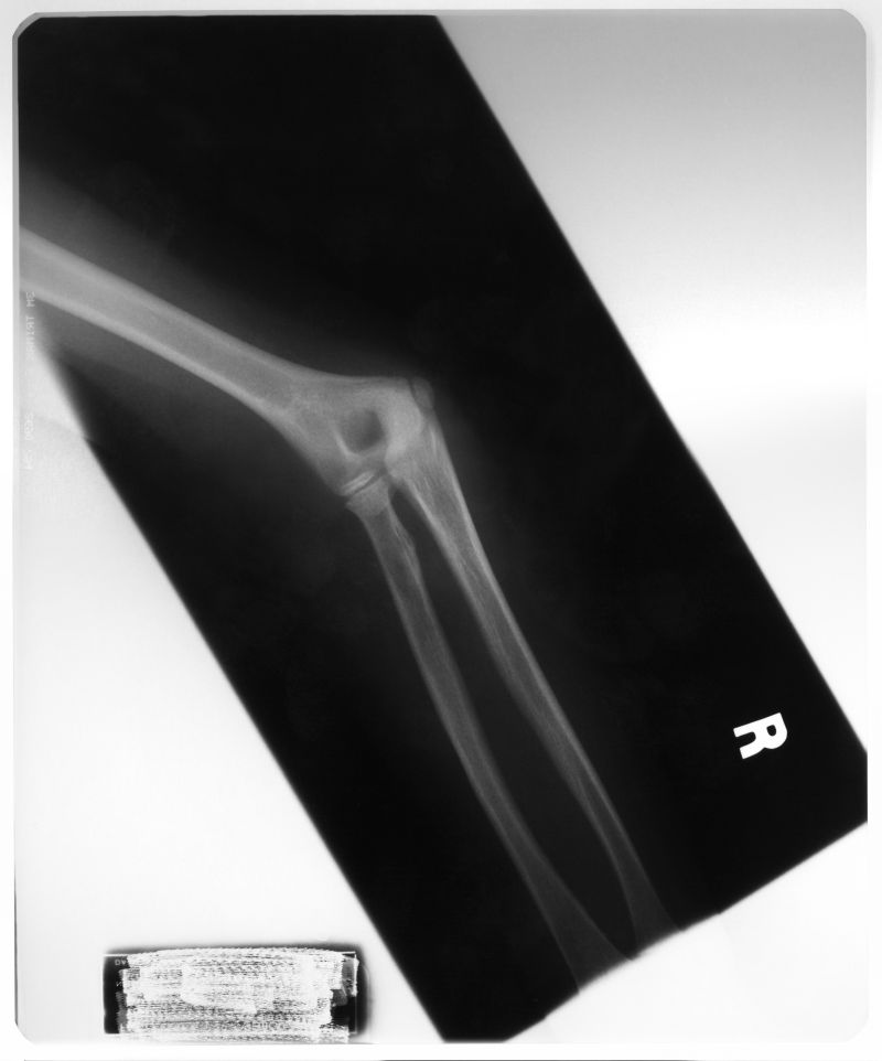 人体手骨的x射线图