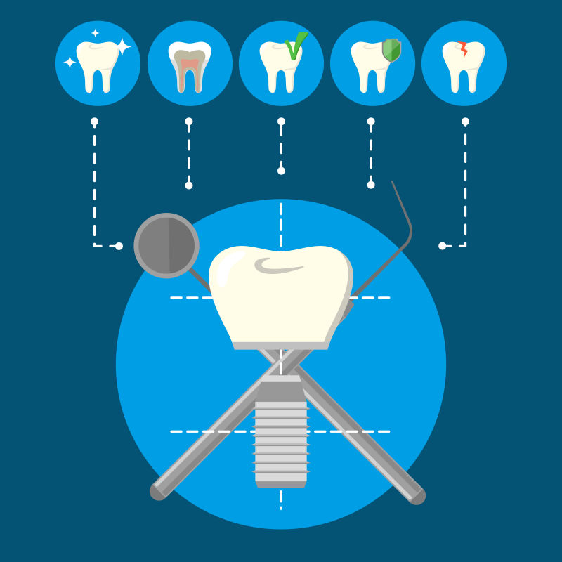 创意矢量种植牙的图示插图