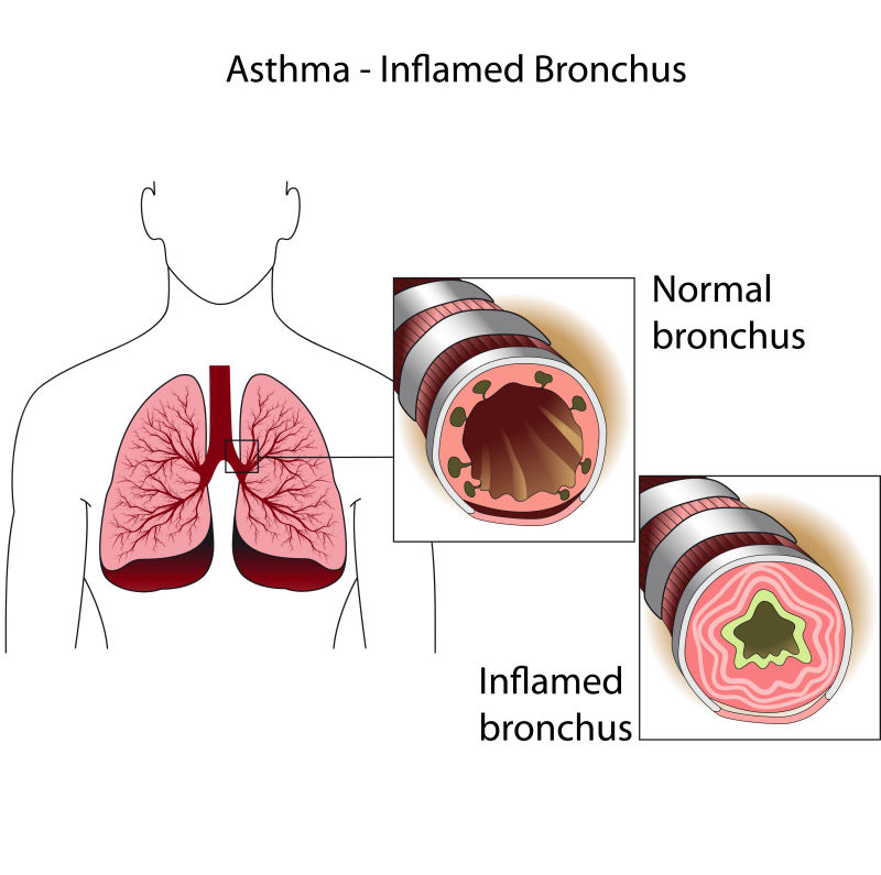 创意矢量哮喘病的医学插图