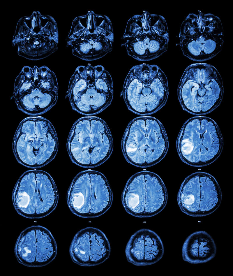MRI脑：右顶叶脑肿瘤