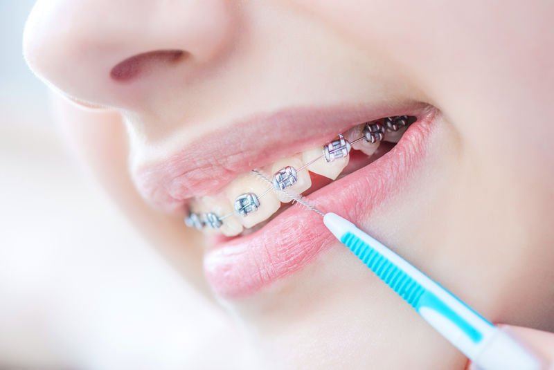 用牙冠和牙刷刷紧女性牙齿，以矫正牙撑。