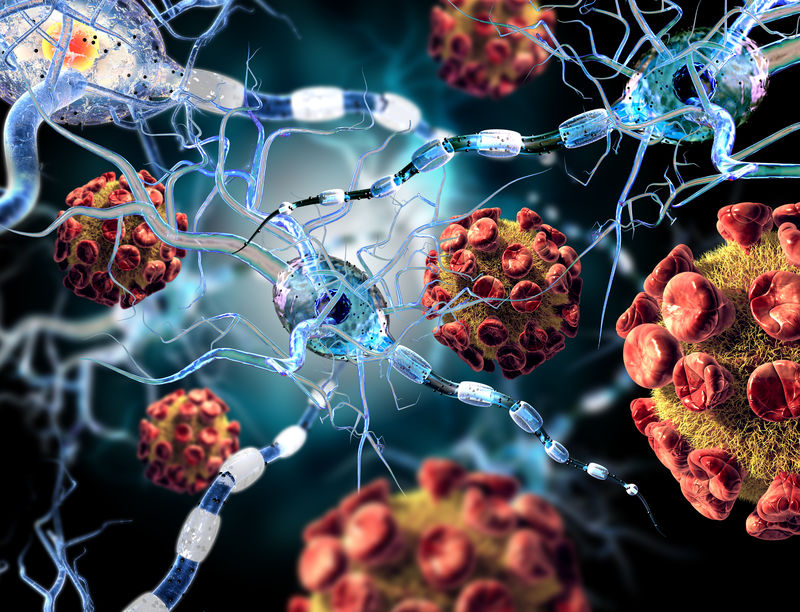 高质量3D呈现攻击神经细胞的病毒-神经疾病、肿瘤和脑部手术的概念
