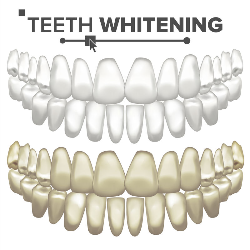 牙齿美白载体。牙科护理。清洁专业牙齿。逼真的独立插图