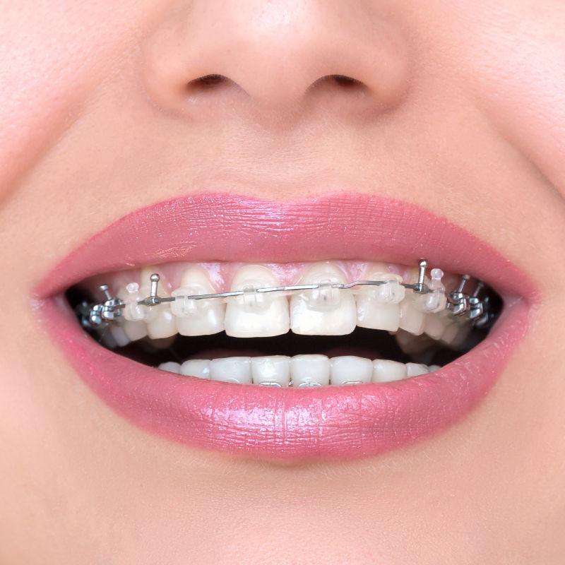 妇女微笑显示牙齿支架
